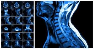 Brain and spine tumors-image
